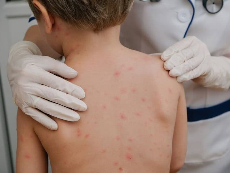 România se confruntă cu criza vaccinării copiilor în fața unei epidemii de rujeolă